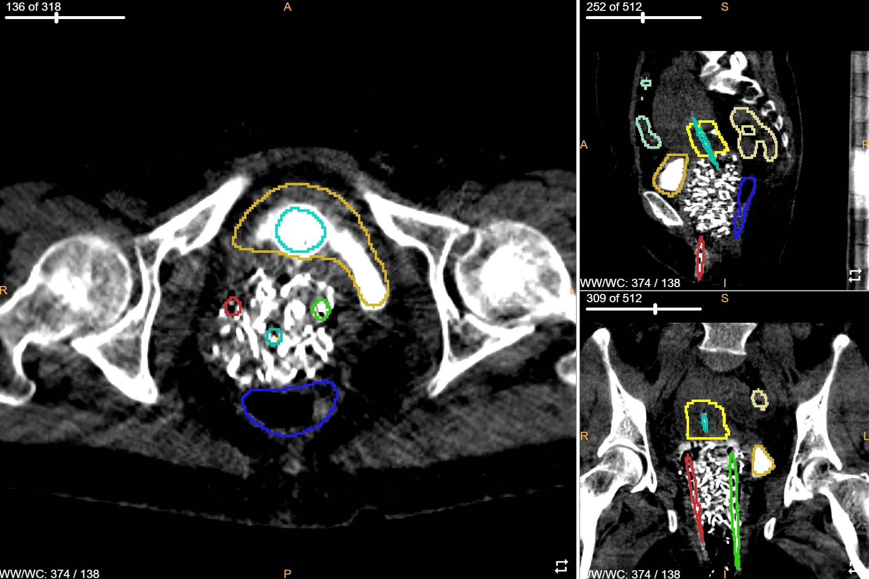 Auto-contoured OARs and target on axial, sagittal, and coronal CT views