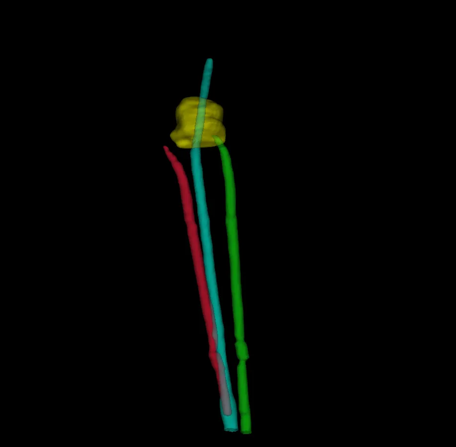 3D rendering of digitized applicator channels with the CTV