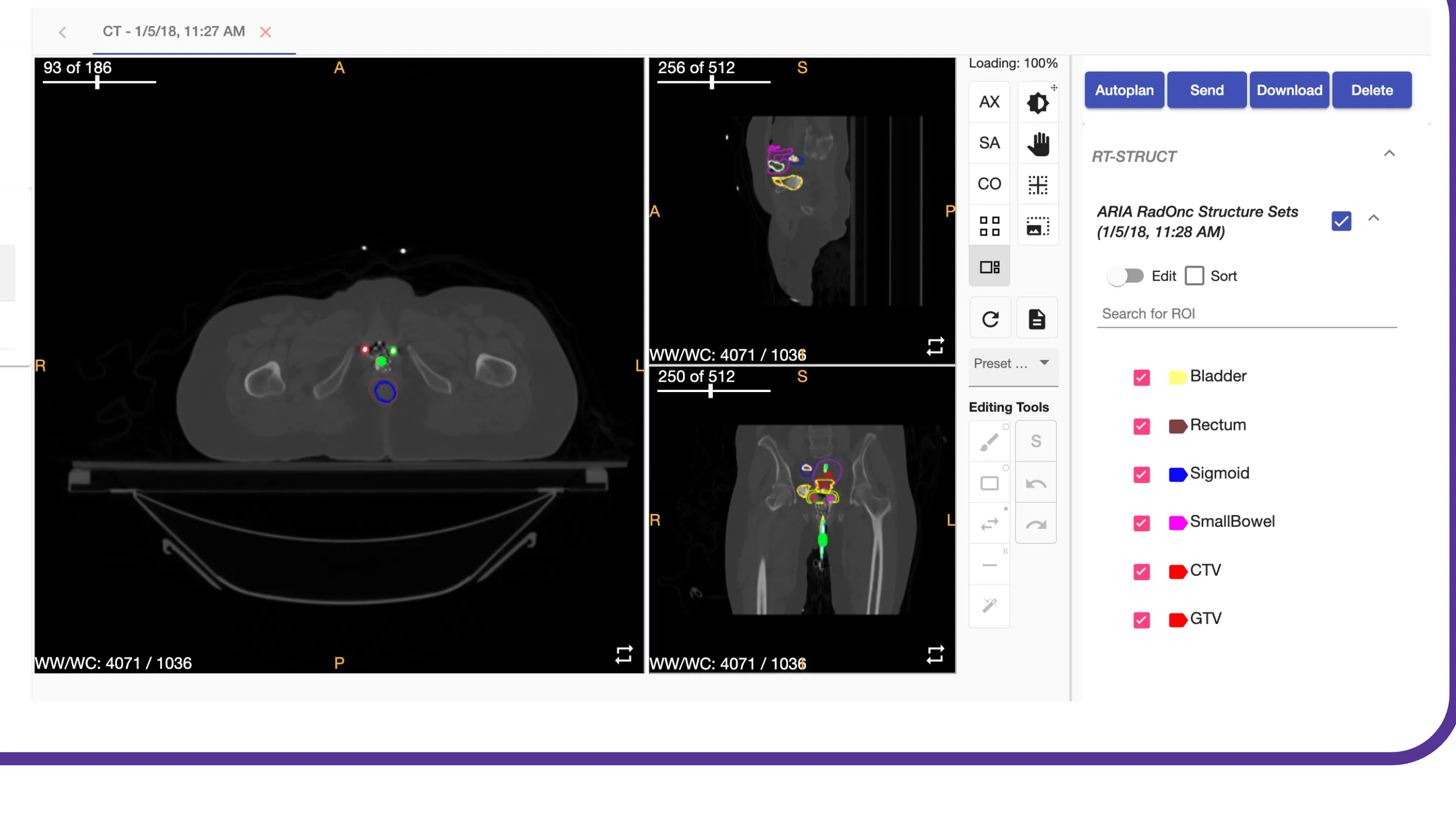 AutoBrachy auto-contouring view with structure list