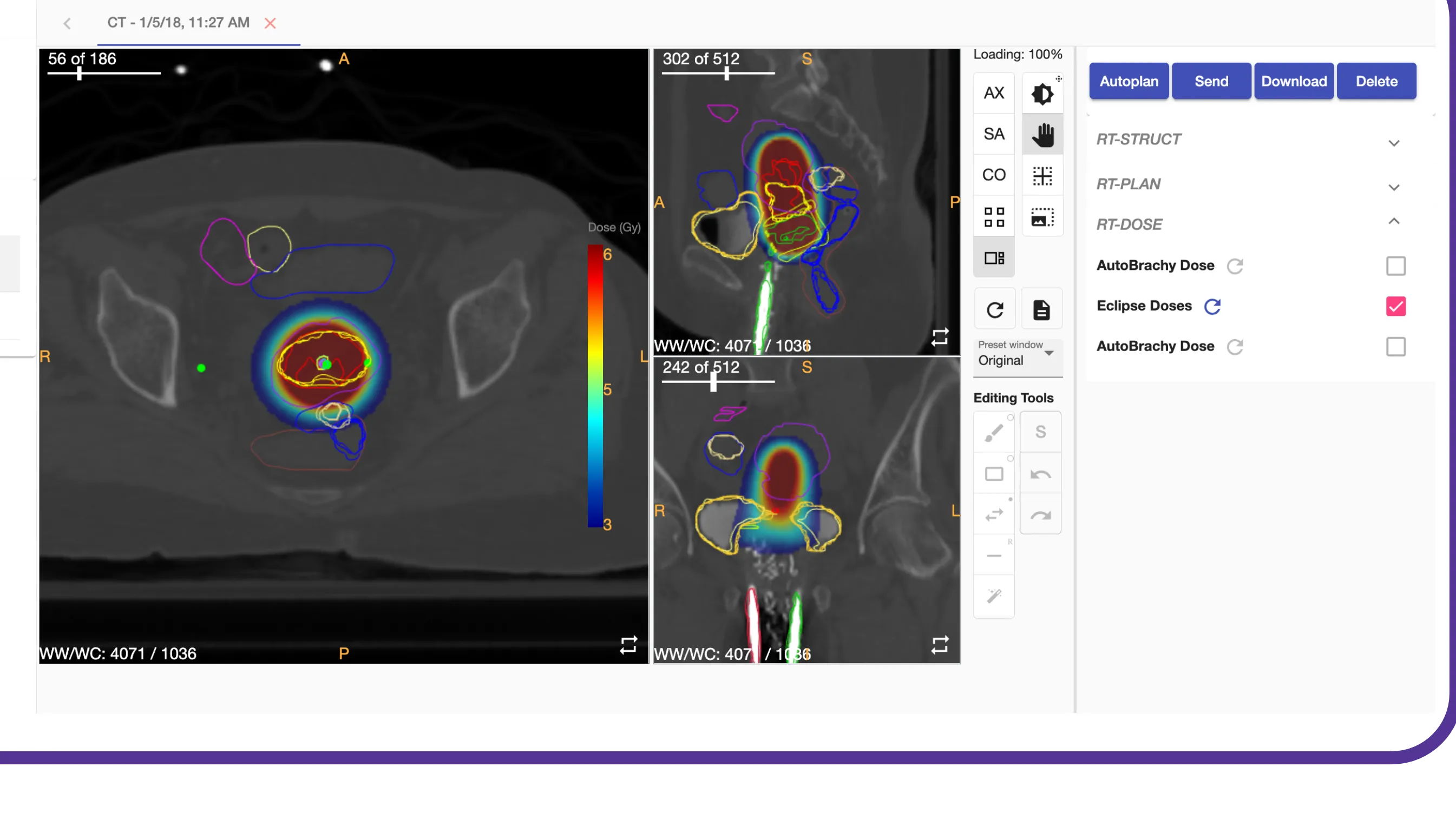 AutoBrachy plan view: isodose overlay with dwell positions on an axial CT slice
